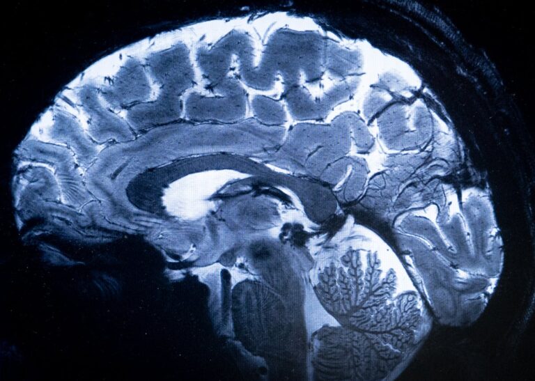 Brain MRI