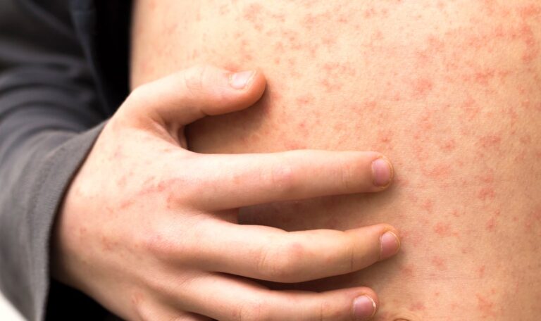 Sick child with red rash spots from measles